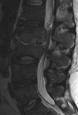 Discitis MRI